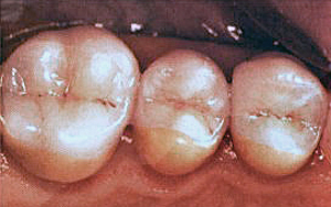 Das Zahnfarbene Inlay